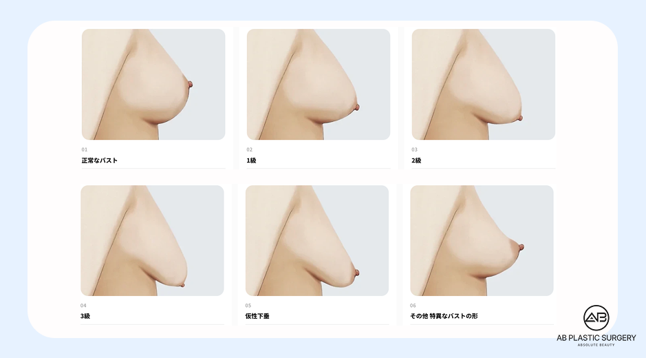 AB美容外科韓国が紹介する垂れ乳セルフチェックと下垂レベル（正常・1～3度・仮性下垂）の比較イメージ