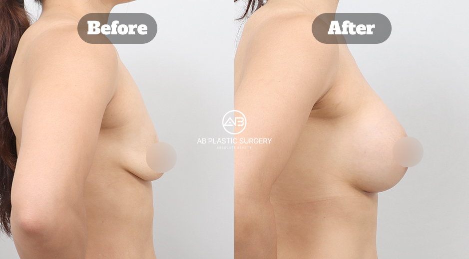 AB美容外科韓国の豊胸手術による垂れ乳改善症例のビフォーアフター写真