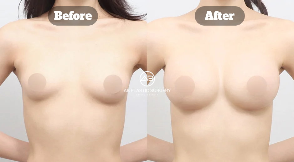 AB美容外科韓国のMotiva豊胸による垂れ乳改善症例、術後3週間のビフォーアフター写真