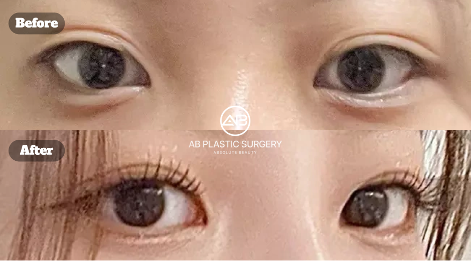 二重埋没の透明癒着法による手術前と11年後を比較した症例写真