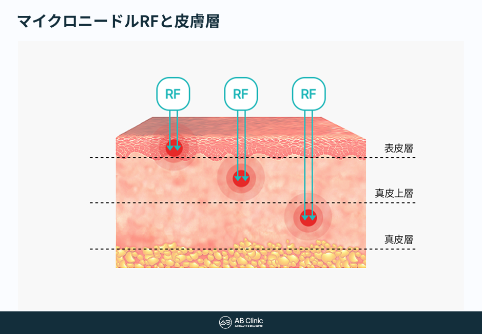 表皮層、真皮上層、真皮層を色分けした皮膚断面図。