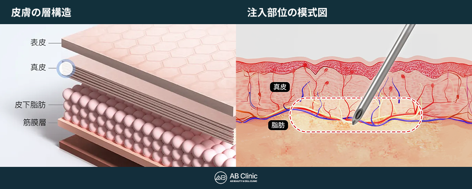 表皮・真皮・皮下脂肪などの層を示す立体模式図、針と注入部位を描いた皮膚断面図。