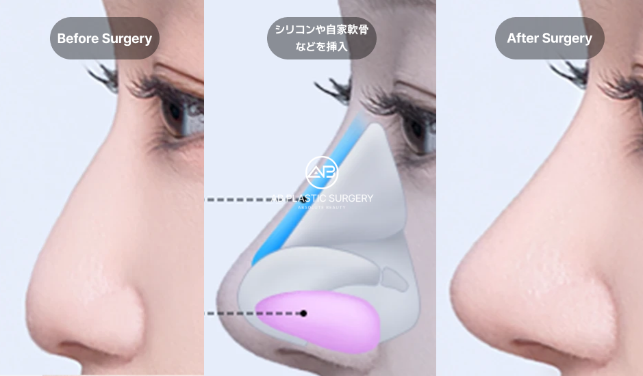 鼻プロテーゼの挿入を示す図。 中央に「シリコンや自家軟骨などを挿入」と表示された挿入位置の模式図。