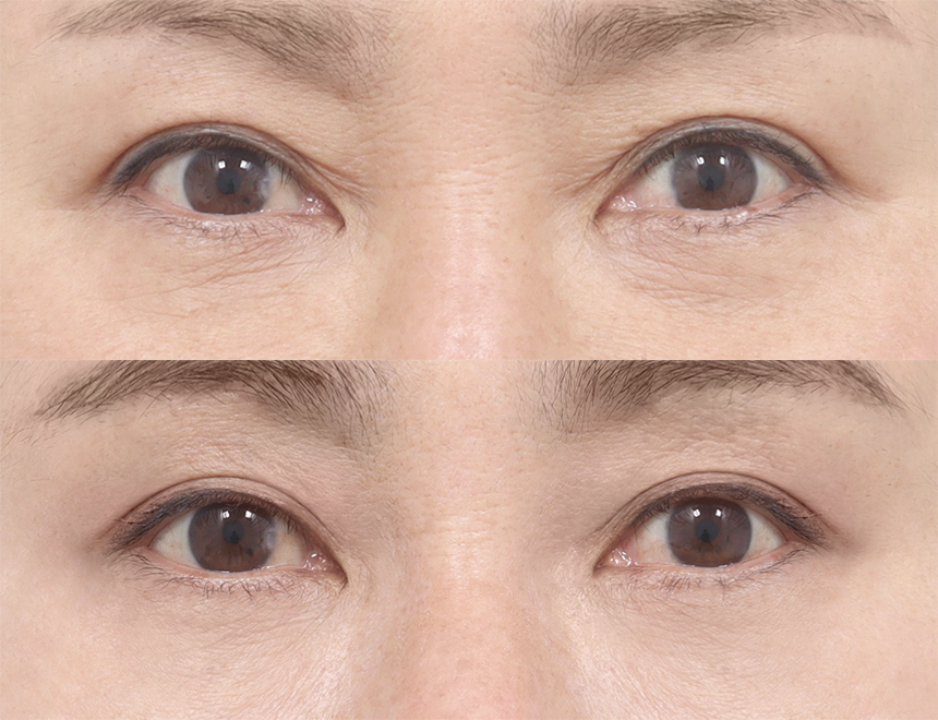 EYE eyelid surgery セレクト美容塾　眼瞼　まぶた　希少 _______front26142040_691998.jpg
