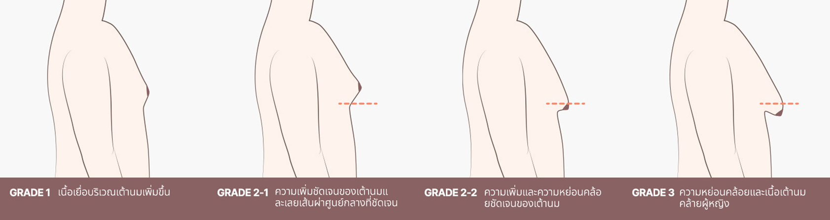 ลักษณะของภาวะเต้านมโตในผู้ชาย