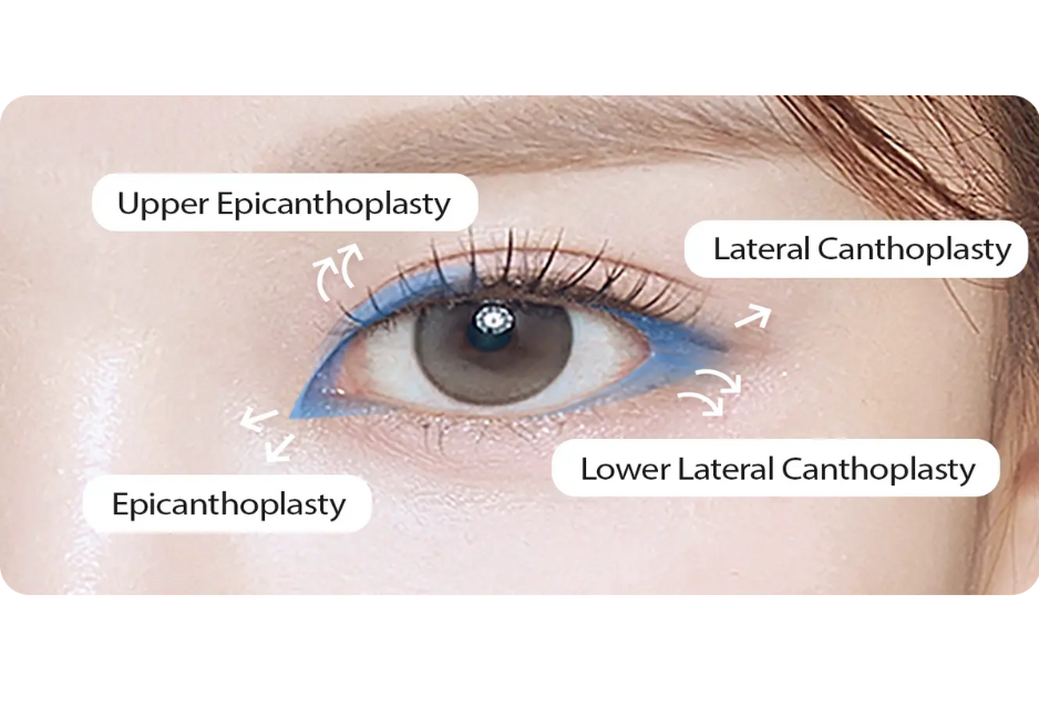 การทำ Canthoplasty ในเกาหลี