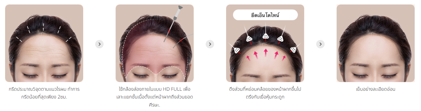 ศัลยกรรมยกกระชับหน้าผากด้วยเอ็นโดไทน์