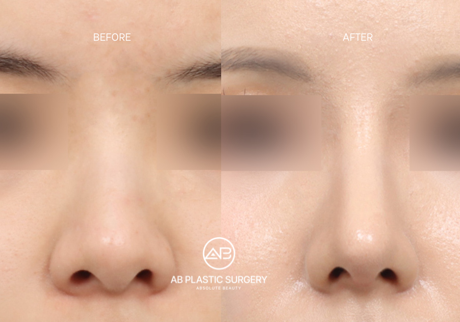 Rhinoplasty at AB Plastic Surgery Korea: Before and After