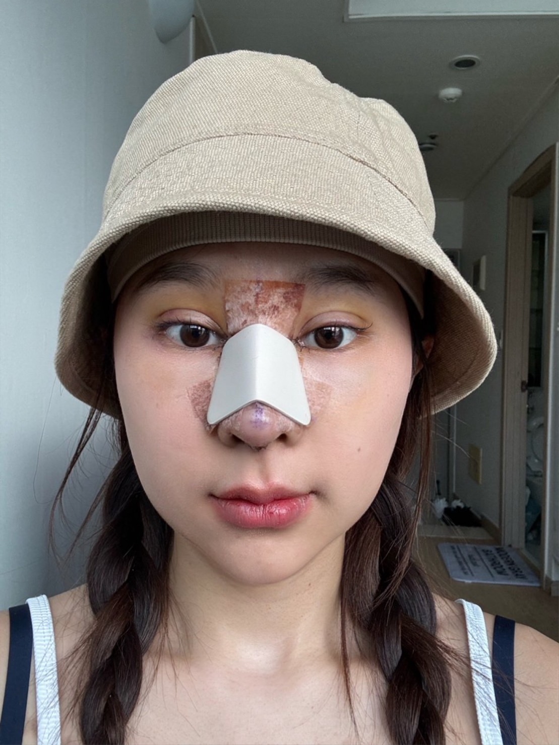 รีวิวหลังศัลยกรรม 7 วัน - คุณบีม littlebeam หลังแก้จมูก ตาสองชั้น และเอนโดไทน์ ที่ AB Plastic Surgery Korea