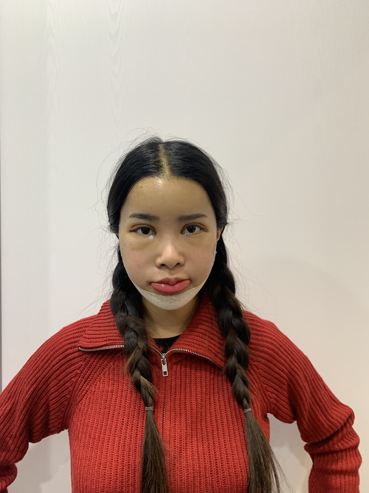 "รีวิวหลังศัลยกรรม 4 วัน - bbinko ตาสองชั้น วีไลน์ เติมไขมัน หน้าเริ่มเข้าที่ - AB Plastic Surgery"