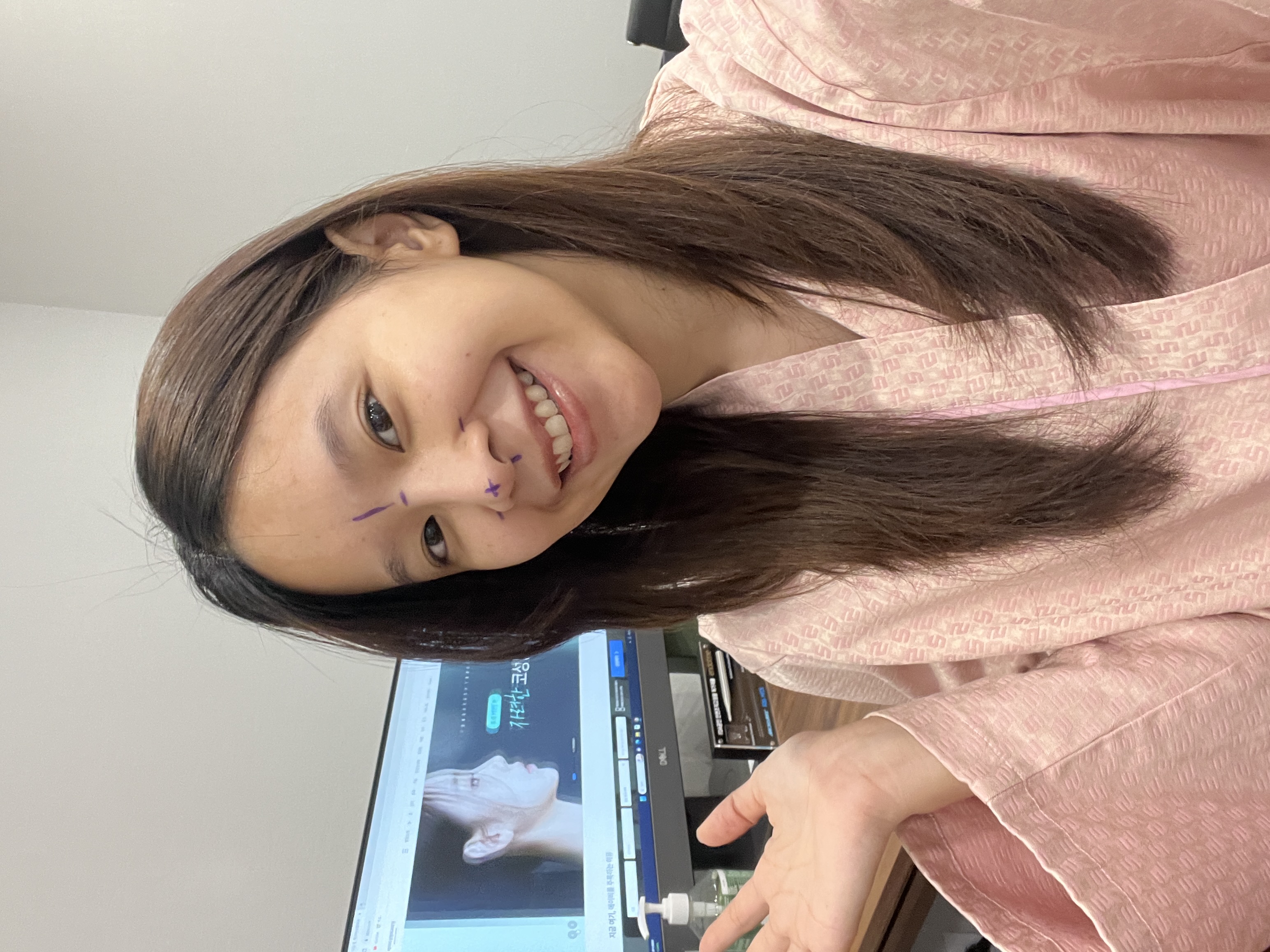 ก่อนศัลยกรรมคุณบีม littlebeam แก้จมูก ทำตาสองชั้น และเอนโดไทน์ที่เกาหลี - AB Plastic Surgery