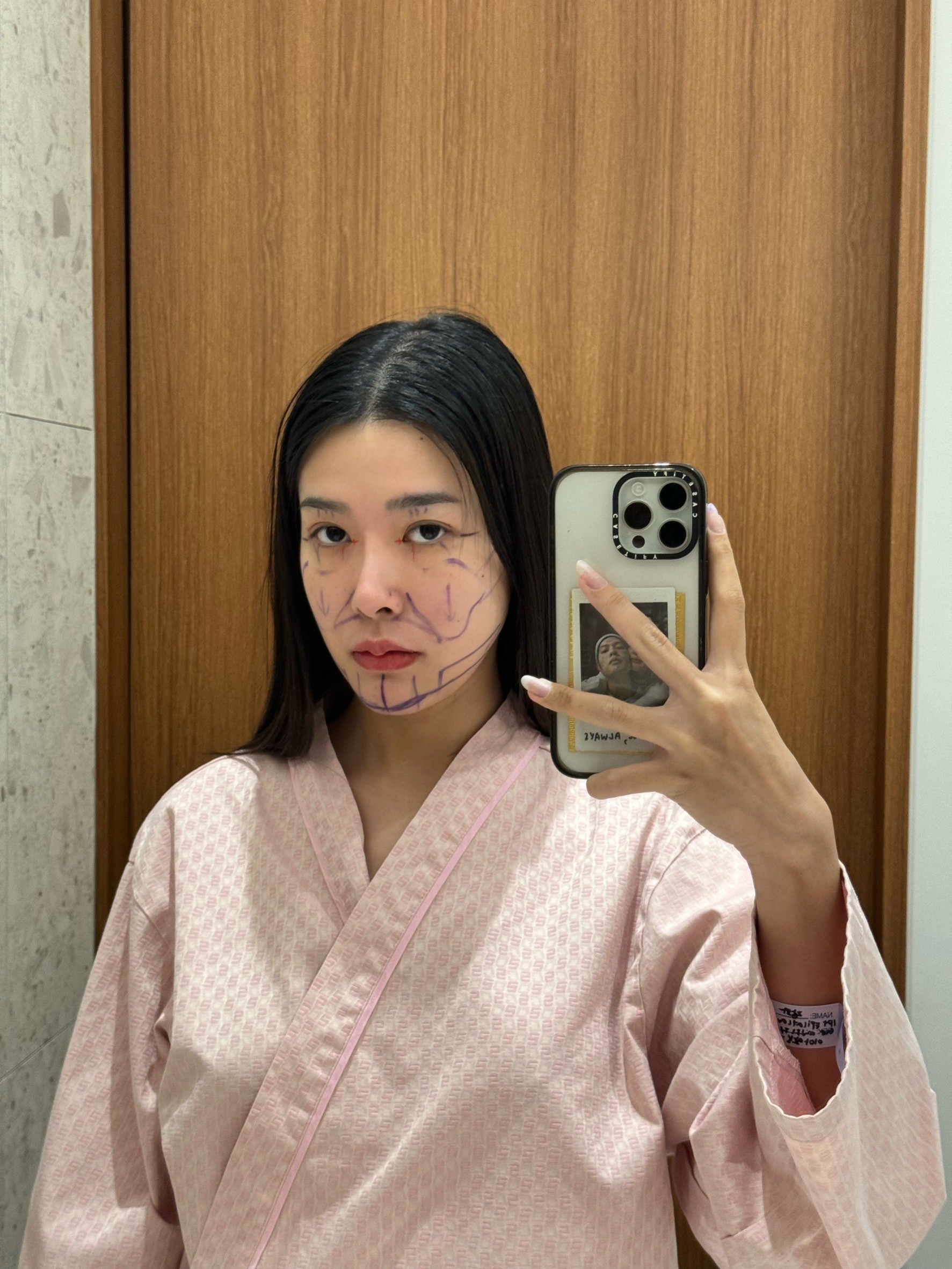 "รีวิวศัลยกรรม bbinko ภาพฟ้า พุทธรักษา - ศัลยกรรมเกาหลีก่อนทำตาสองชั้น วีไลน์ และเติมไขมัน - AB Plastic Surgery"