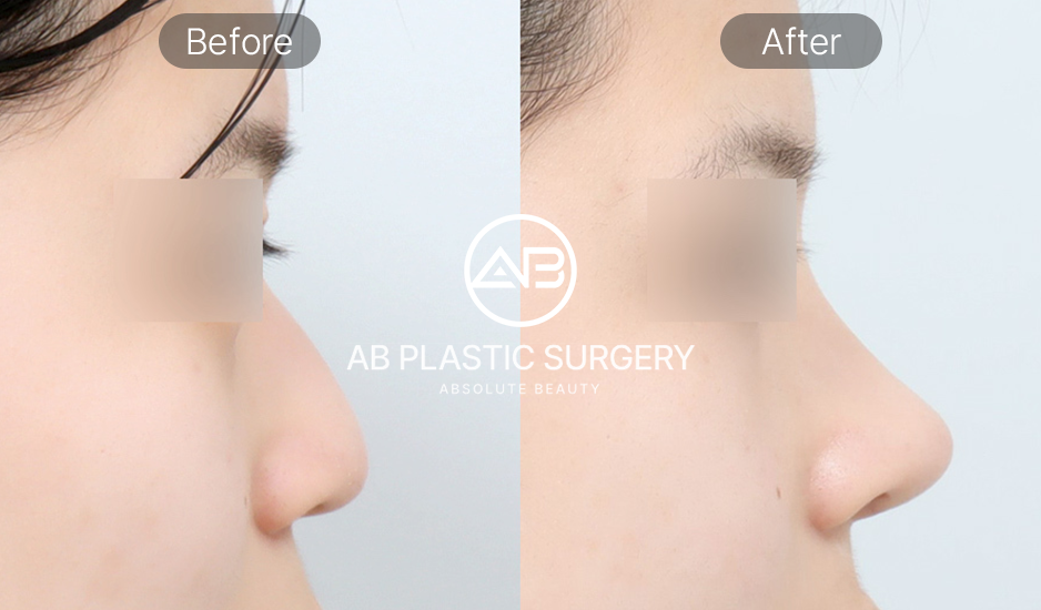 การเปลี่ยนแปลงก่อนและหลังศัลยกรรมจมูก