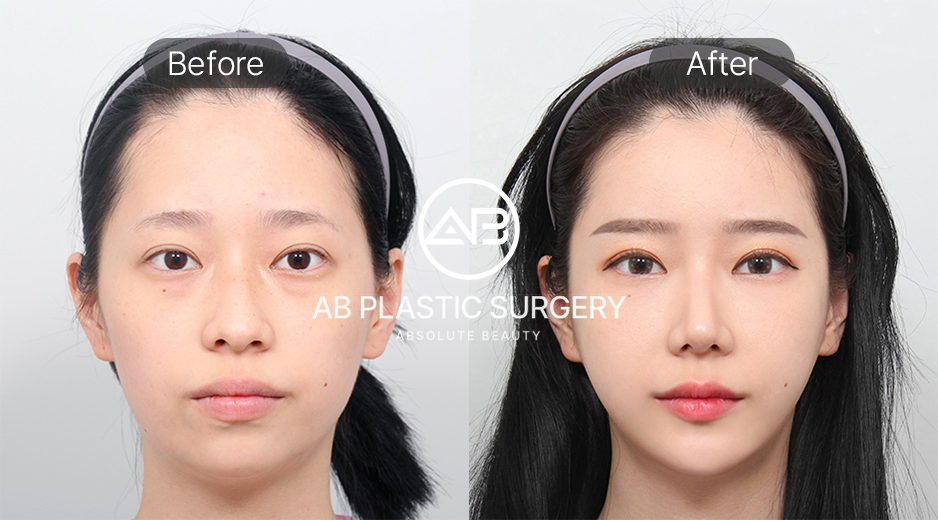 ภาพก่อนและหลังศัลยกรรมโครงหน้าเกาหลี 3 จุด