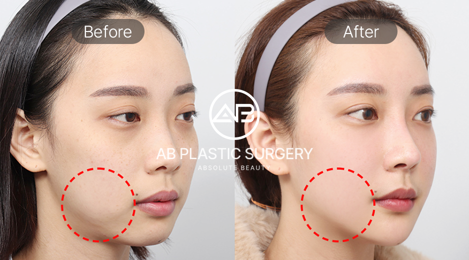 เปรียบเทียบก่อนและหลังศัลยกรรมโหนกแก้ม