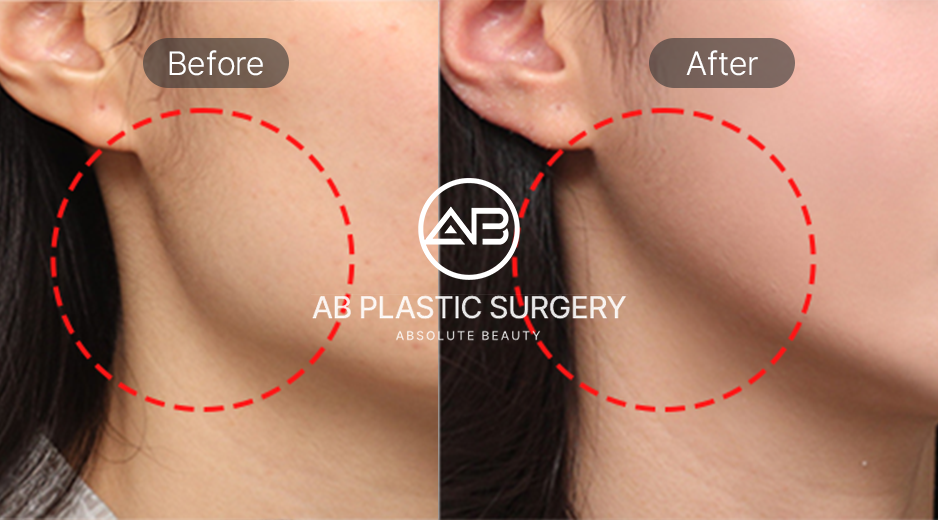 ภาพก่อนและหลังศัลยกรรมโครงหน้ากรามเหลี่ยม