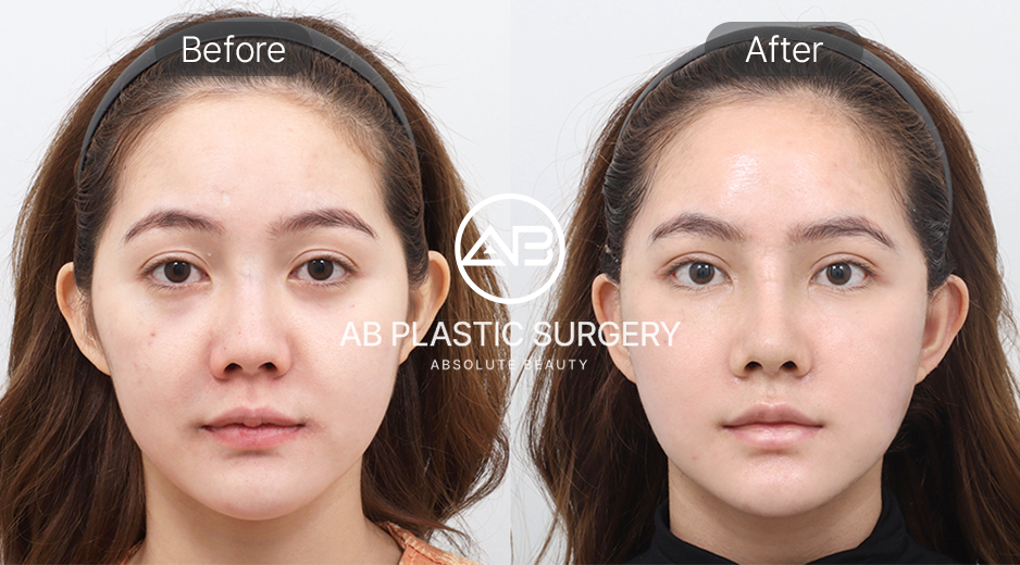 ผลลัพธ์ของการทำเฟซลิฟท์