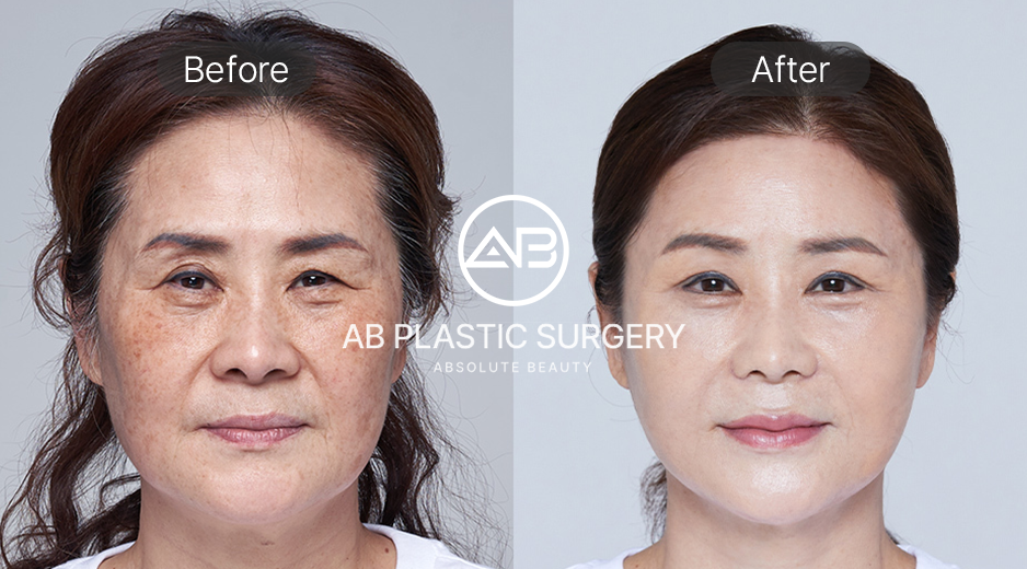 เปรียบเทียบภาพก่อนและหลังศัลยกรรมเฟซลิฟท์ในเกาหลี