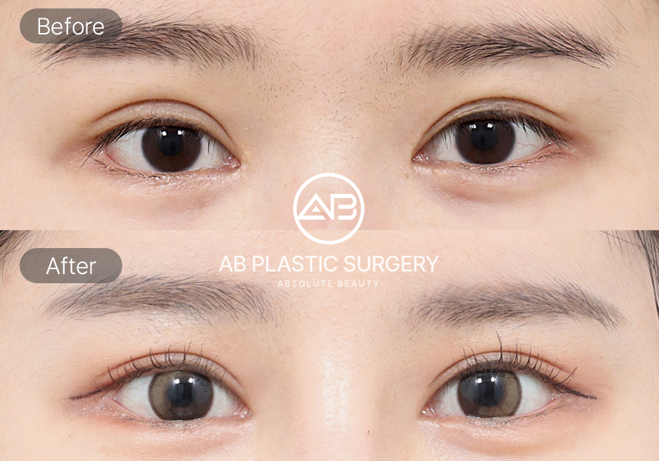 รูปก่อนและหลังศัลยกรรมปรับกล้ามเนื้อตาแบบเกาหลี