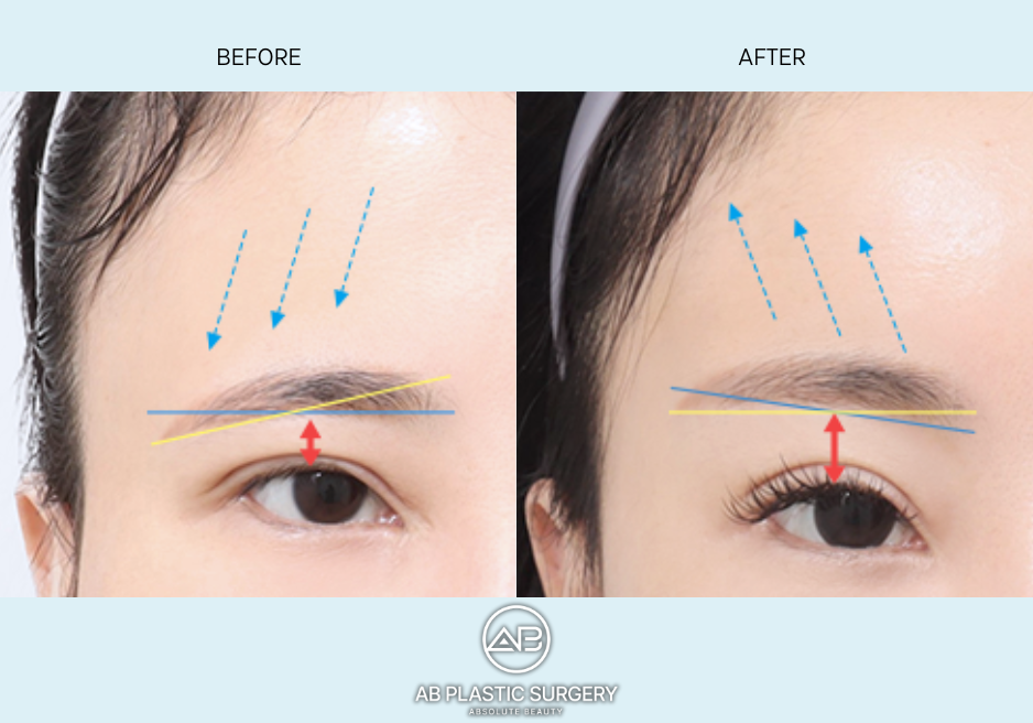 ก่อนและหลังศัลยกรรมยกคิ้ว ที่ AB Plastic Surgery Korea
