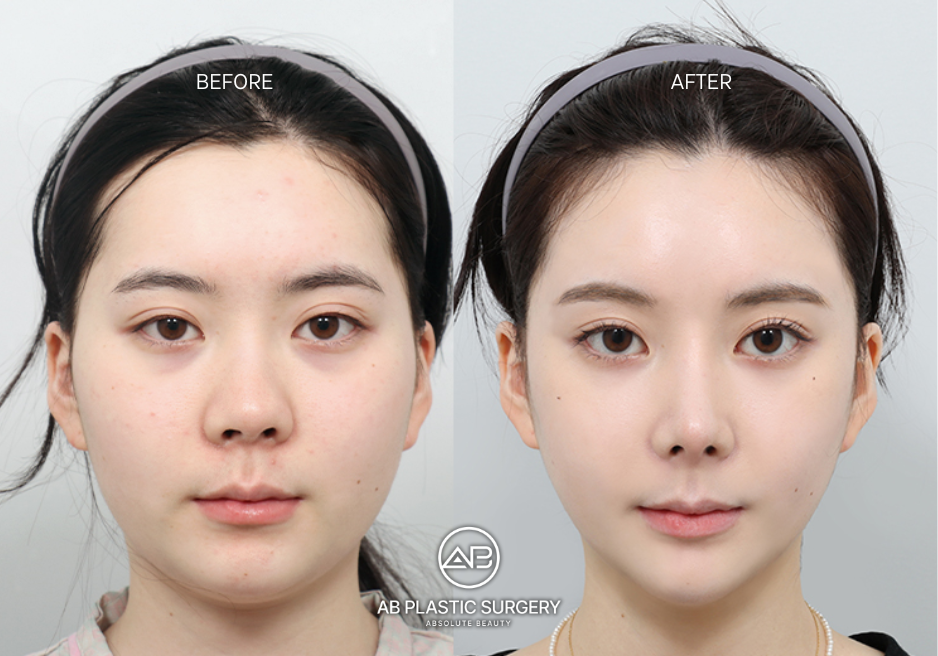 ศัลยกรรมคาง ที่ AB Korea Plastic Surgery