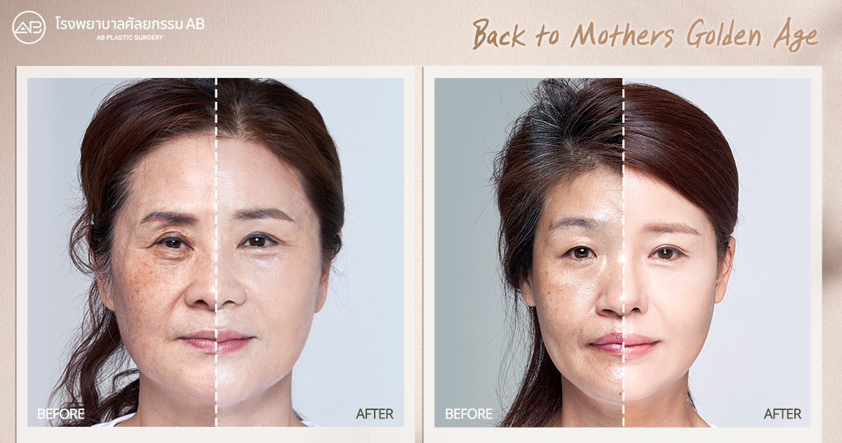 AB_PLASTIC_SURGERY_OZEMPIC_FACE_BEFORE_AFTER_BACK_TO_MOTHERS_GOLDEN_AGE
