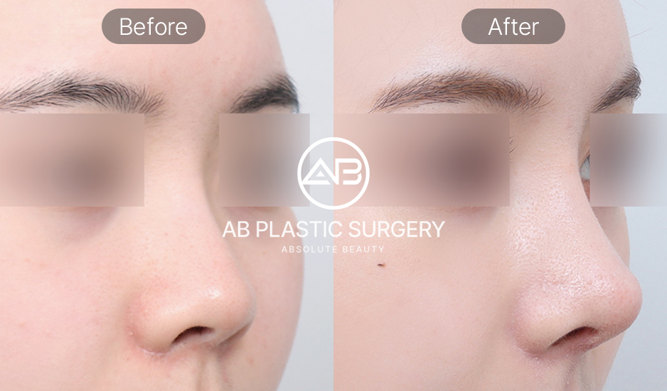 ภาพมุมเฉียงก่อนและหลังเสริมจมูกหยดน้ำ