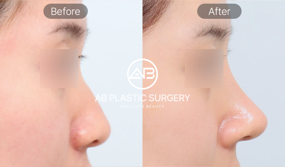 ผลลัพธ์การศัลยกรรมปลายจมูกเกาหลี