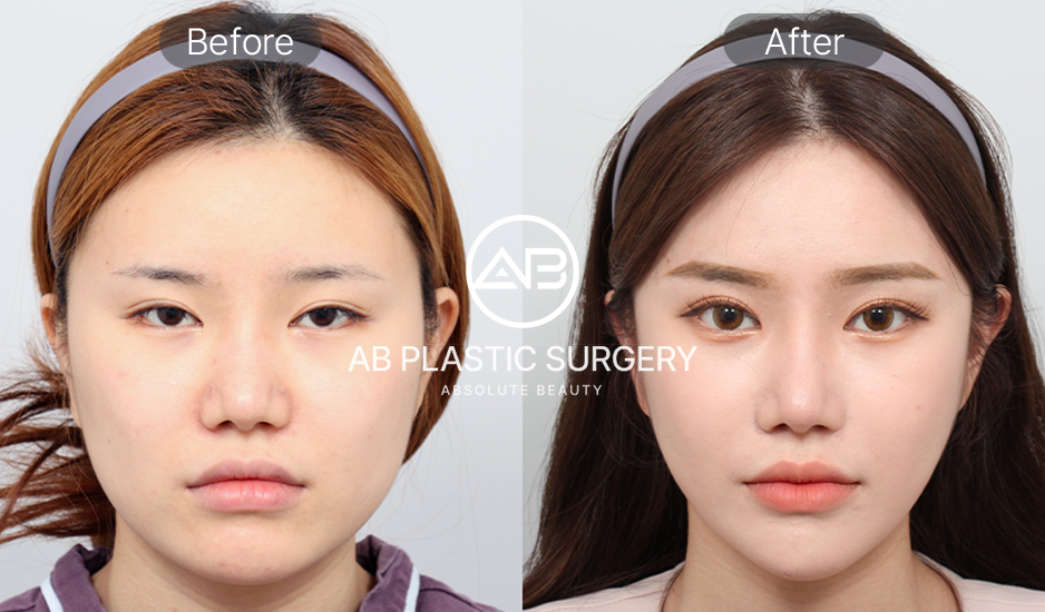 วิธีทำให้หน้าเรียว – ศัลยกรรมปรับรูปหน้าเกาหลี ก่อนหลัง
