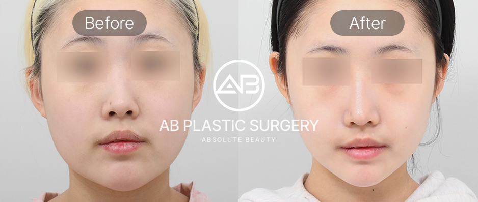 วิธีทำให้หน้าเรียว – ผลลัพธ์ศัลยกรรมปรับรูปหน้าเกาหลี