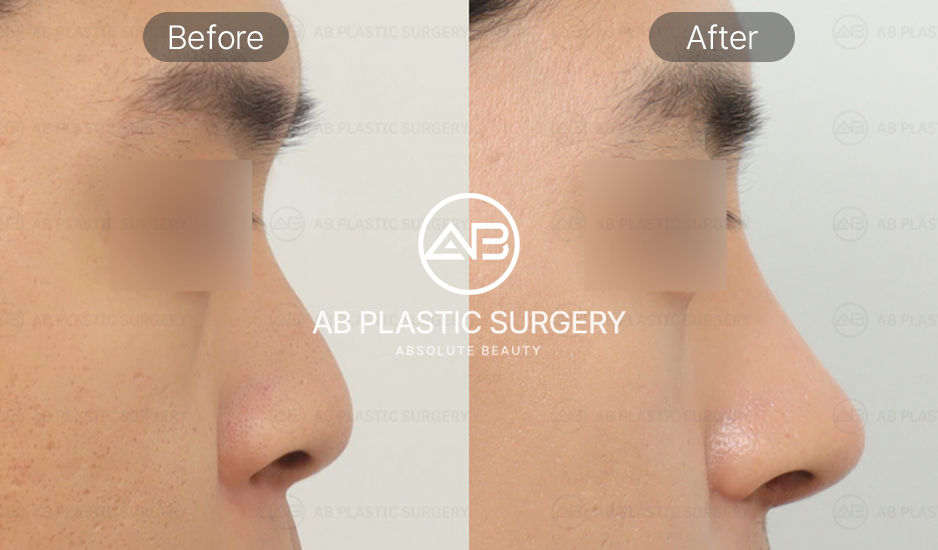 รูปก่อนและหลังศัลยกรรมจมูกผู้ชายเกาหลี