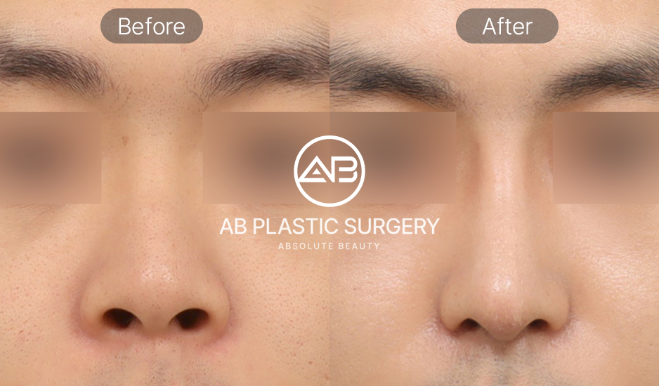 รูปก่อนและหลังศัลยกรรมจมูกผู้ชายเกาหลีมุมตรง