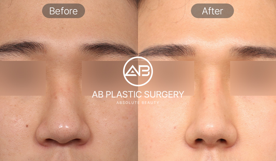 ผลลัพธ์ศัลยกรรมจมูกผู้ชายเกาหลี