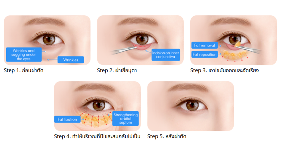 กระบวนการศัลยกรรมกำจัดไขมันใต้ตาในเกาหลี