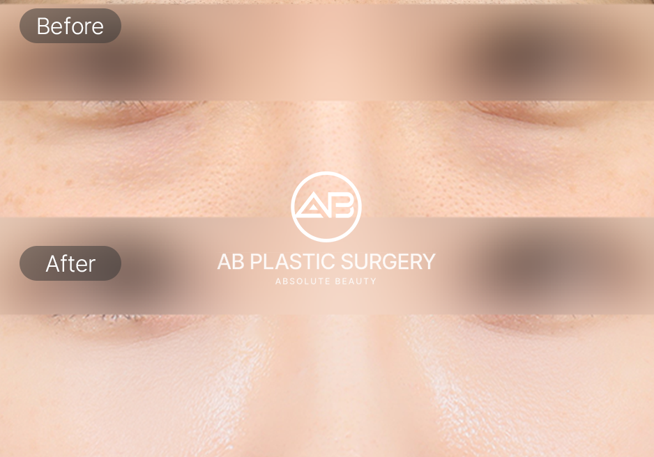 ภาพเปรียบเทียบก่อนและหลังศัลยกรรมกำจัดไขมันใต้ตา