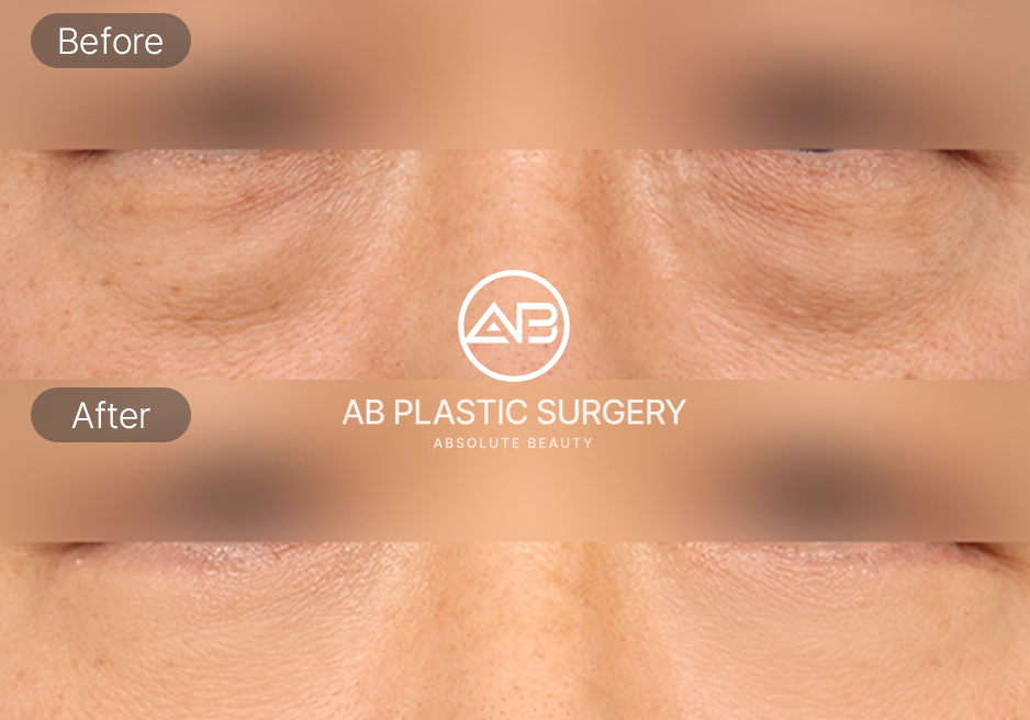 ผลลัพธ์ศัลยกรรมกำจัดไขมันใต้ตา โรงพยาบาลศัลยกรรม AB เกาหลี