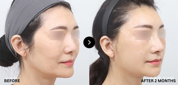 AB_PLASTIC_SURGERY_OZEMPIC_FACE_REVIEW_BEFORE_AND_AFTER