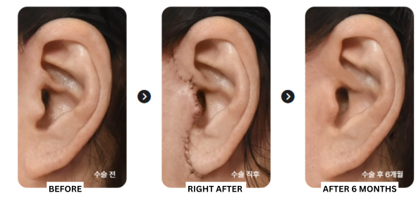 AB_PLASTIC_SURGERY_OZEMPIC_FACE_REVIEW_BEFORE_AND_AFTER