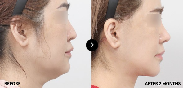 AB_PLASTIC_SURGERY_OZEMPIC_FACE_REVIEW_BEFORE_AND_AFTER