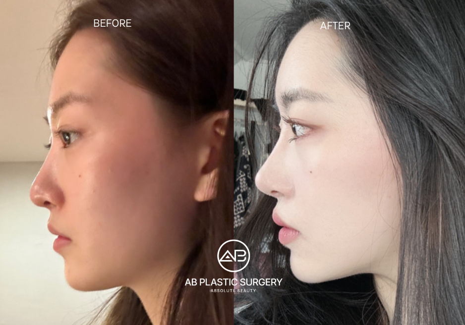 สันจมูกที่สูงคือมาตรฐานความงามของสาวเกาหลี