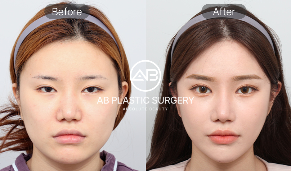ภาพก่อนและหลังศัลยกรรมหน้าเรียวที่เกาหลี