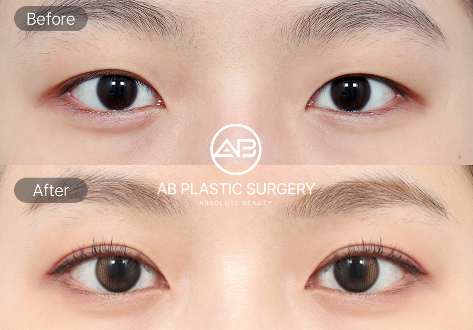 รูปก่อนและหลังศัลยกรรมตาสองชั้นเกาหลี