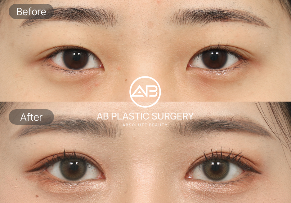 ภาพผลลัพธ์ศัลยกรรมตาสองชั้นเกาหลี