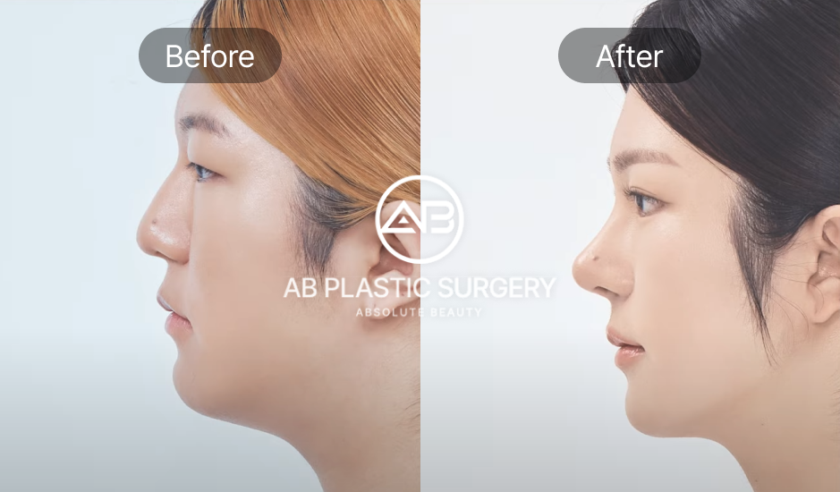 ผลลัพธ์ศัลยกรรมแปลงเพศในเกาหลี