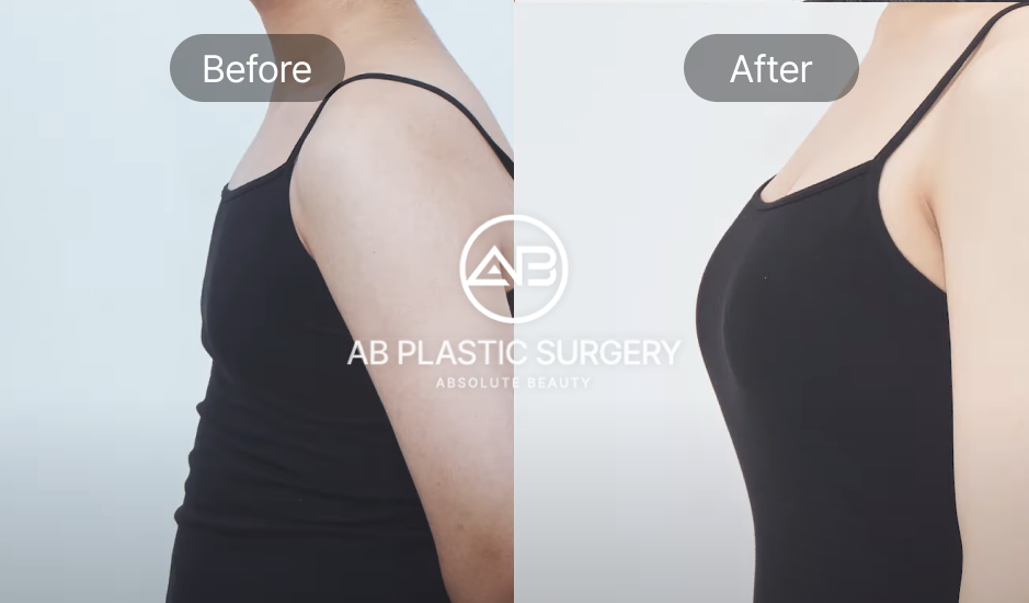 ภาพศัลยกรรมหน้าอกสำหรับคนข้ามเพศ