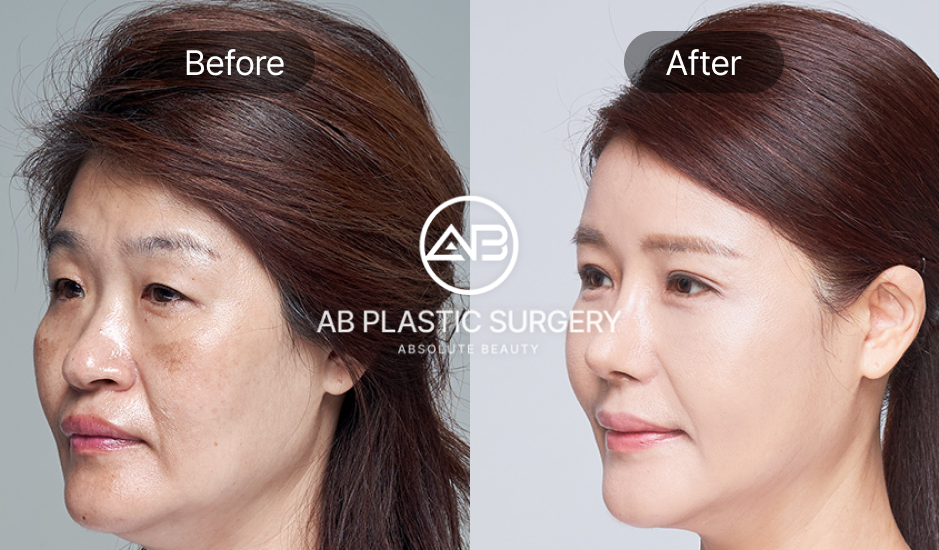 เปรียบเทียบก่อนและหลังการยกกระชับใบหน้าที่เกาหลี