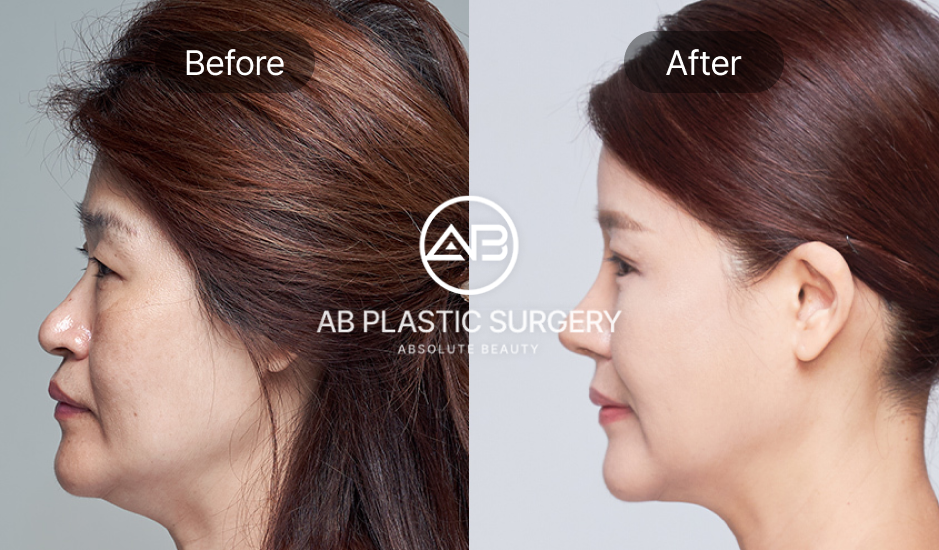 รูปภาพด้านข้างของการยกกระชับใบหน้าที่เกาหลี