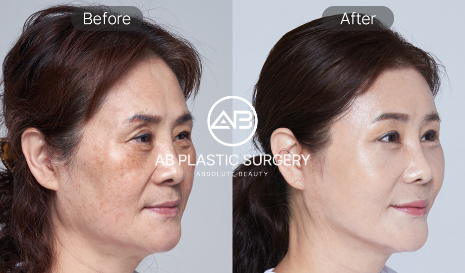 ยกกระชับใบหน้า เคล็ดลับสู่ผิวอ่อนเยาว์