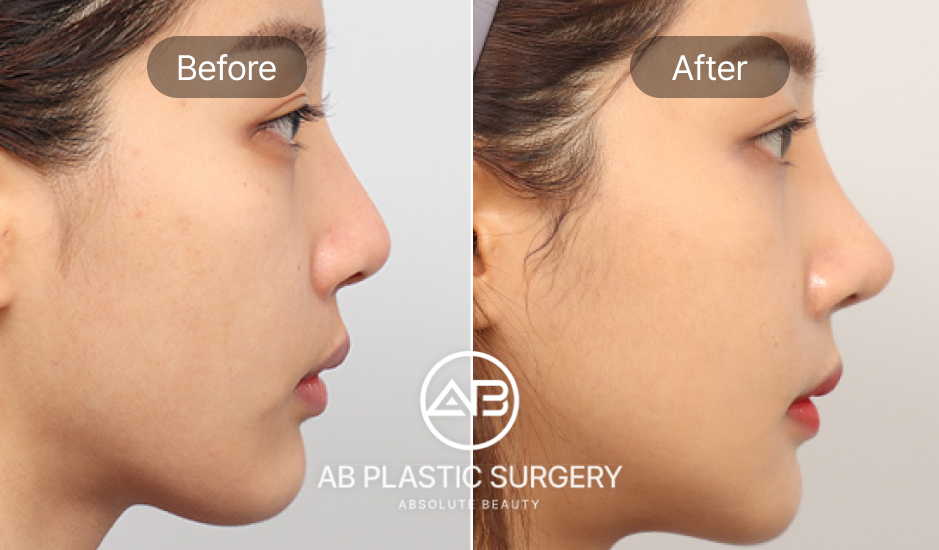 รูปภาพศัลยกรรมเสริมจมูกก่อนหลัง เกาหลีโรงพยาบาลศัลยกรรมAB