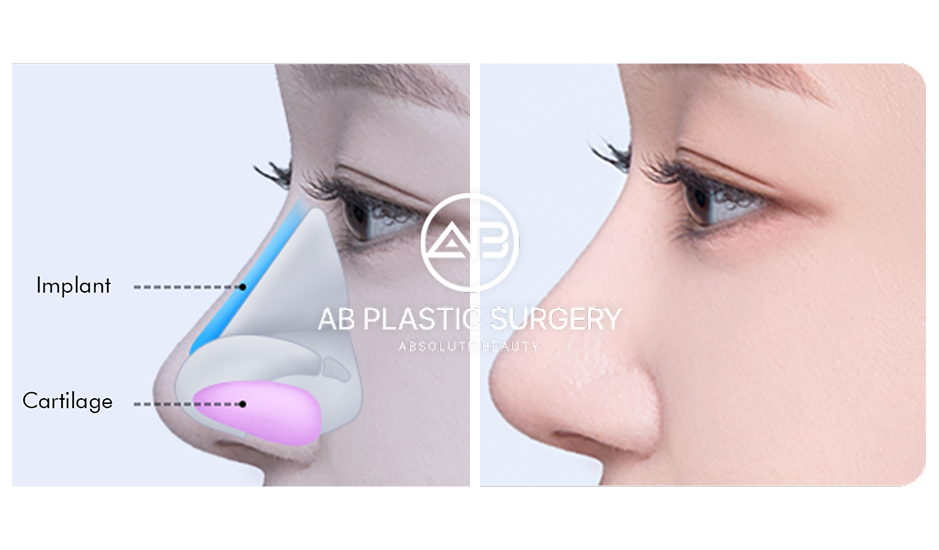 โครงสร้างเสริมจมูก เกาหลีโรงพยาบาลศัลยกรรมAB ซิลิโคน กระดูกอ่อน รูปภาพเทคนิคเสริมจมูก